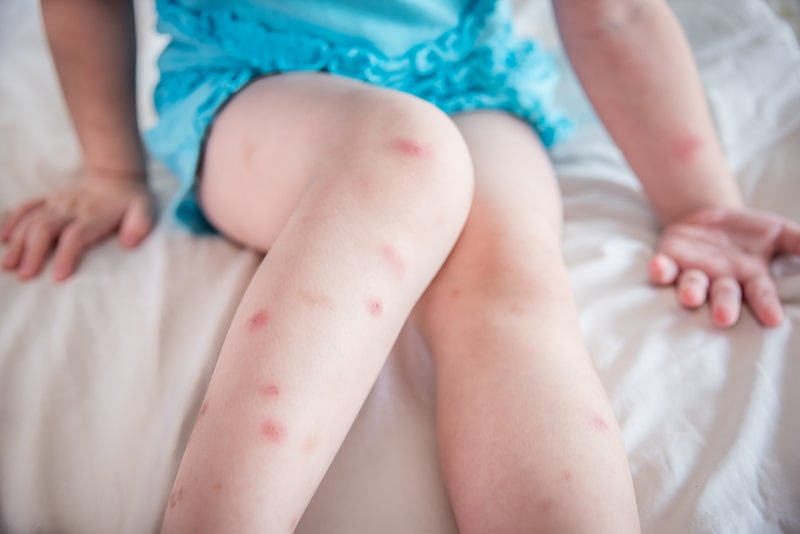 bed bug bite rashes