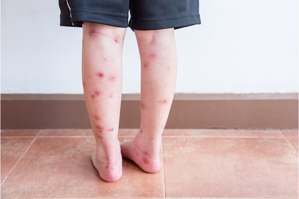 bed bug bites on back of legs