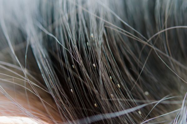 Head lice and nits