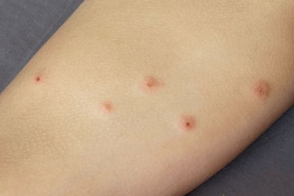 Bed bug bites